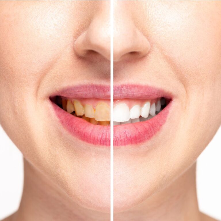 teeth whitening luton